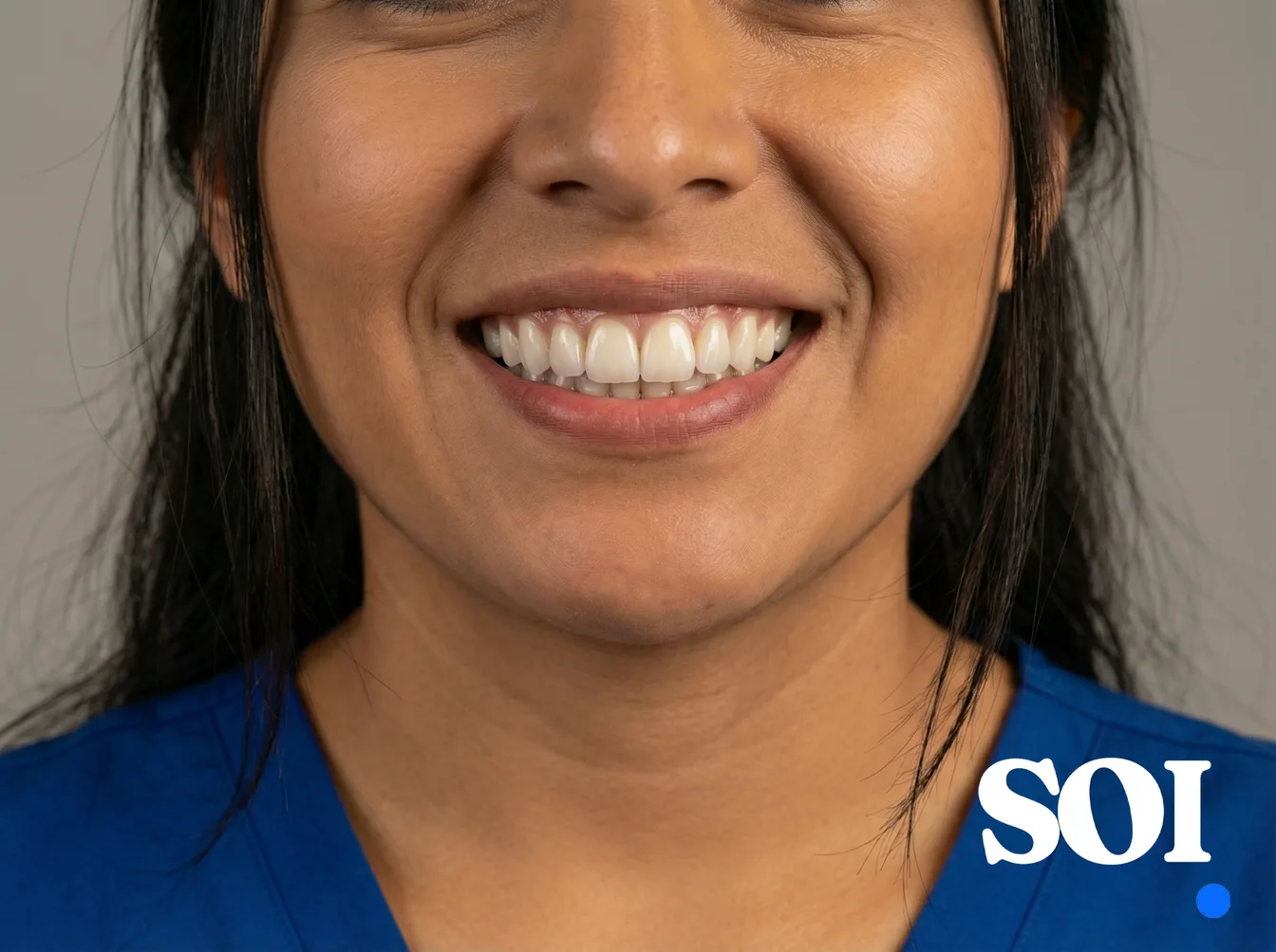 Después del tratamiento con carillas dentales — SOI Quito