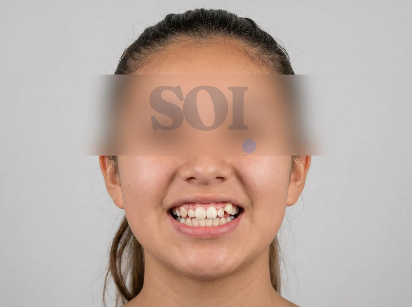 Antes del tratamiento de ortodoncia — SOI Quito